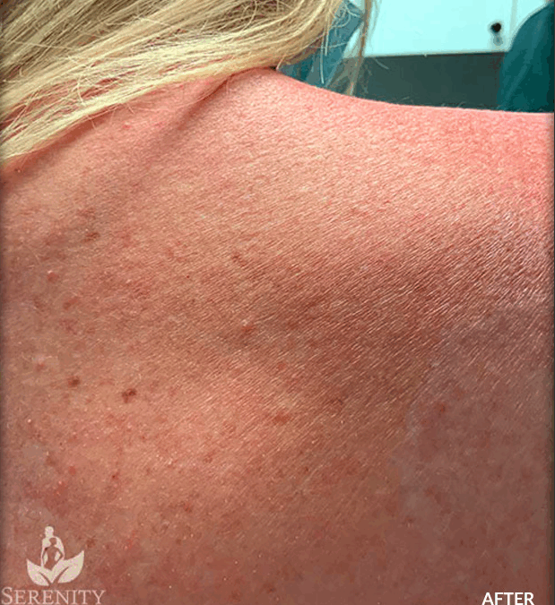 Preparing for Your Tattoo Removal Session in Seattle