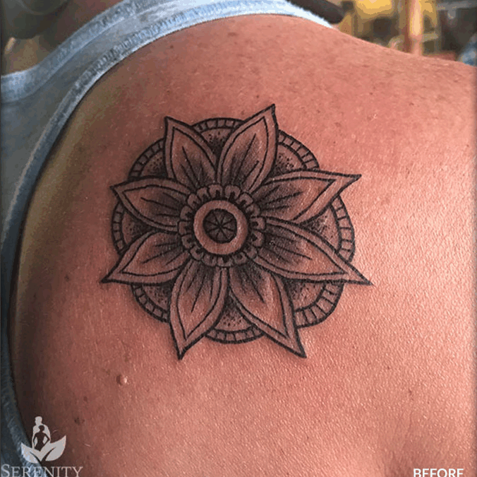 Comparing Tattoo Removal Technologies in Seattle
