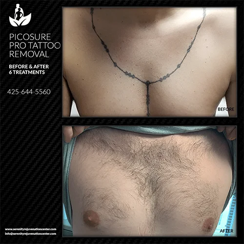 tattoo-removal1