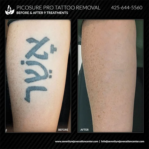 tattoo-removal2