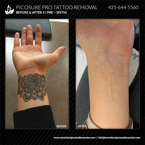 tattoo-removal3