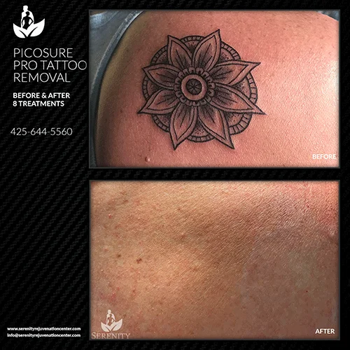 tattoo-removal4