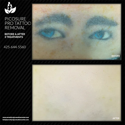 tattoo-removal5