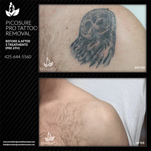tattoo-removal6