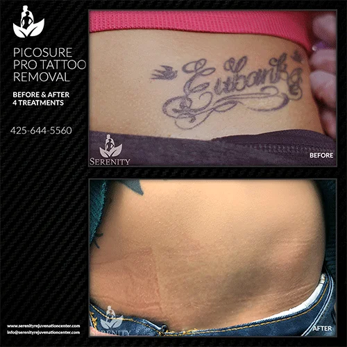 tattoo-removal7