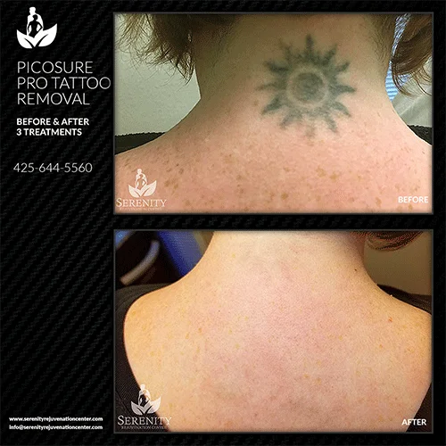 tattoo-removal8