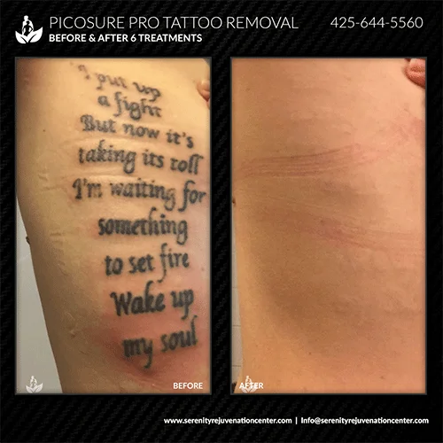 tattoo-removal9