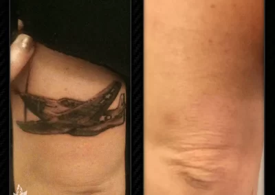 Dr. Stephen O’connell Offering Picosure in Bellevue