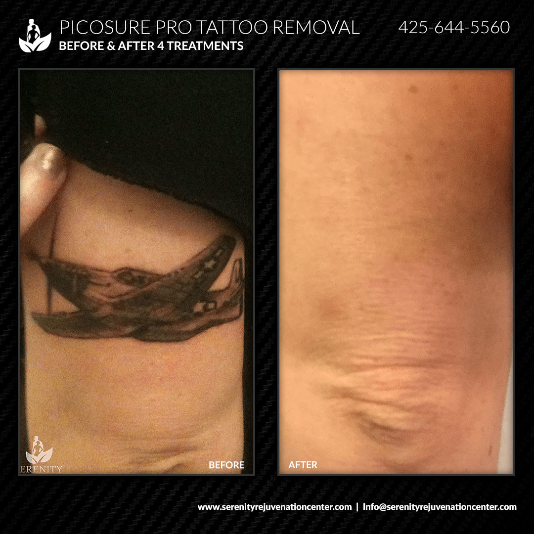 Tattoo-Removal-Case-Study-Image