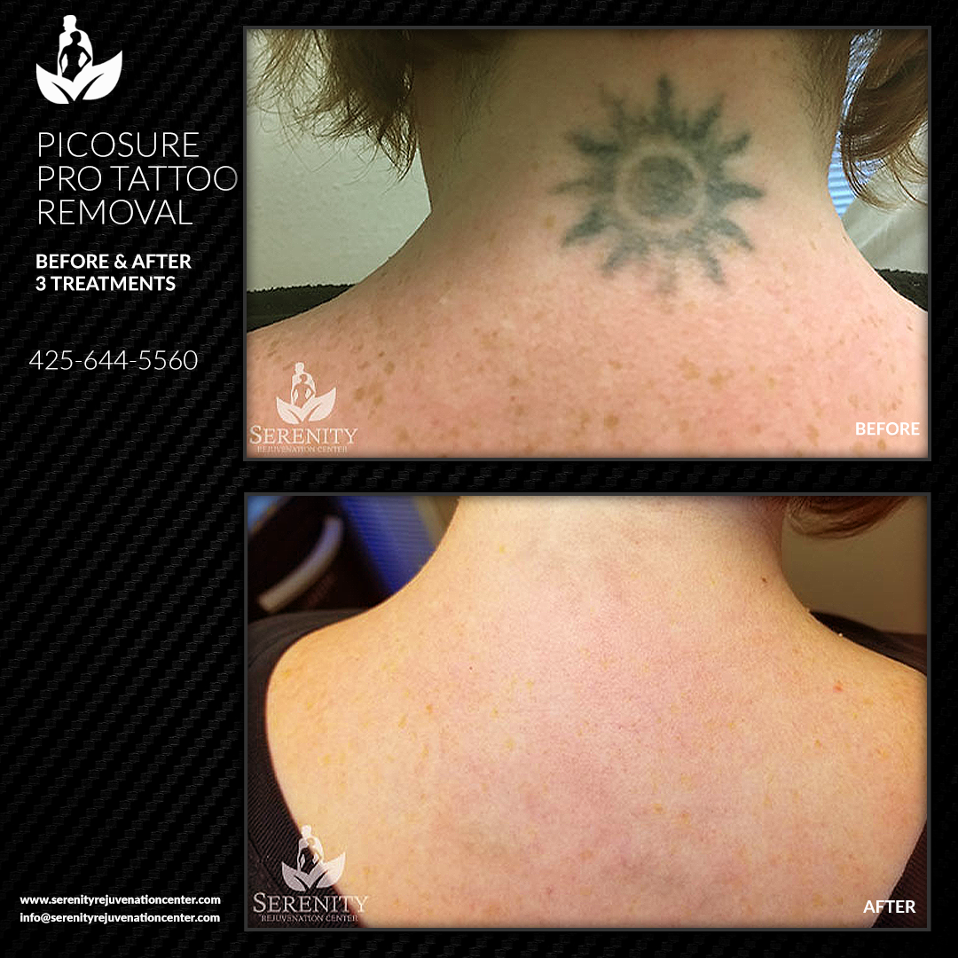 Tattoo-Removal-Neck-Case-Study-Image
