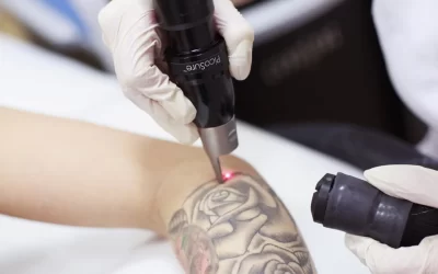 Safe Tattoo Removal in Seattle: Understanding Side Effects