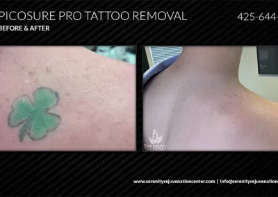 Complete Tattoo Removal Guide Seattle Dr. Stephen O’connell