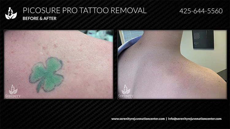 Complete Tattoo Removal Guide Seattle Dr. Stephen O’connell