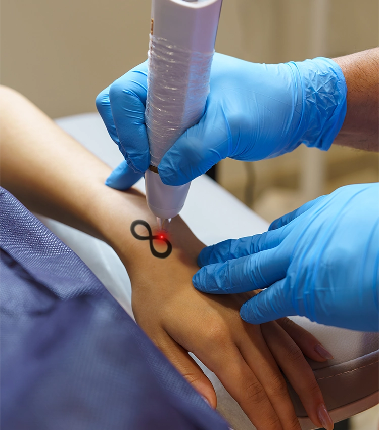 Professional Tattoo Removal in Washington Office