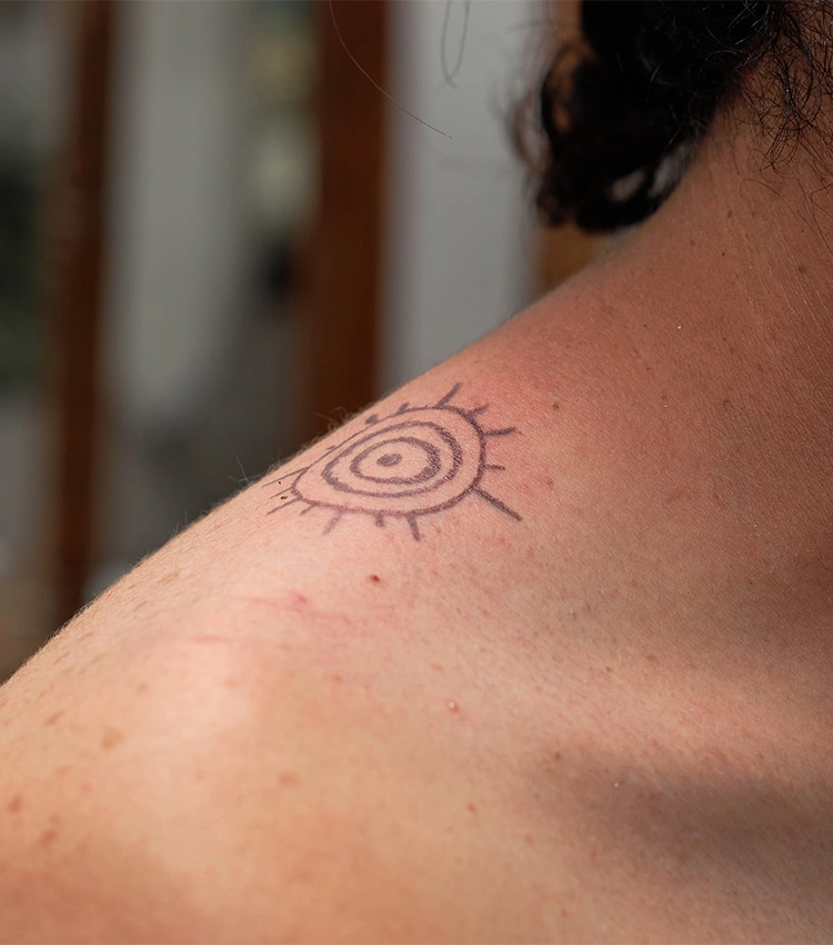Risks and Side Effects of Tattoo Removal